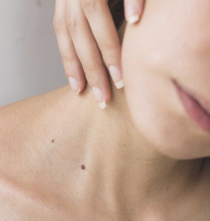 Ukočenost vrata jedan je od simptoma početne faze osteohondroze vratne kralježnice