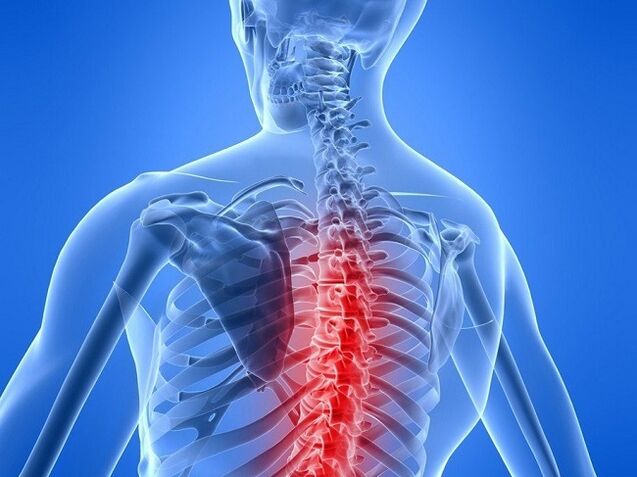 osteohondroza torakalne kralježnice
