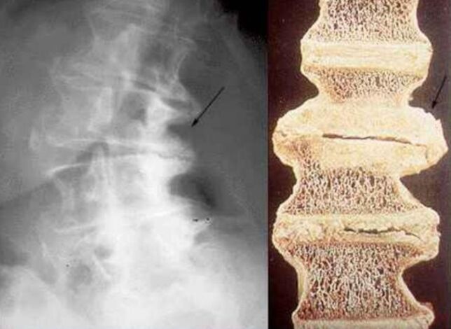 oštećenje kralježaka u torakalnoj osteohondrozi
