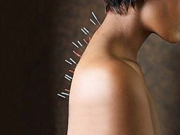 Refleksoterapija je učinkovita metoda liječenja cervikalne osteohondroze